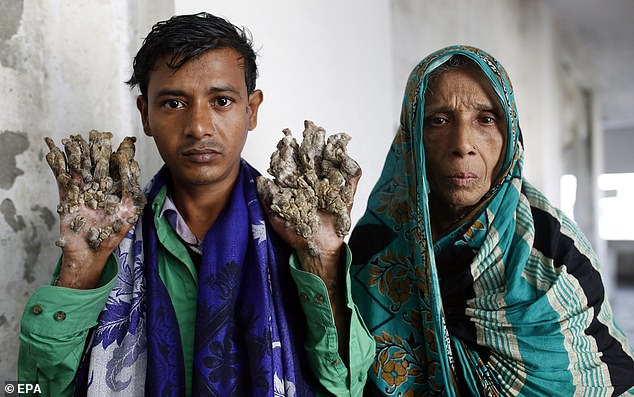 Abul Bajandar, who suffers from rare skin disorder known as treeman syndrome (Epidermodysplasia verruciformis) stands with his mother as he awaits treatment at the Dhaka Medical College (DMC) in Dhaka