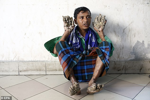 Known as Bangladesh's 'tree man' he had to beg doctors to relieve him of his unbearable pain and amputate his hands which were covered in bark-like growths