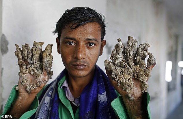 Abul Bajandar, 28, has had 25 operations since 2016 to remove growths on his hands and feet caused by a rare condition