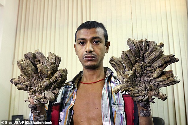 But the father-of-one was readmitted to hospital in January because the condition worsened, with some growths several inches long