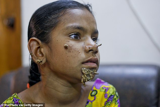 Muktamoni, the Bangladeshi girl's upper body has been ravaged by 'tree-man' disease, local reports suggest