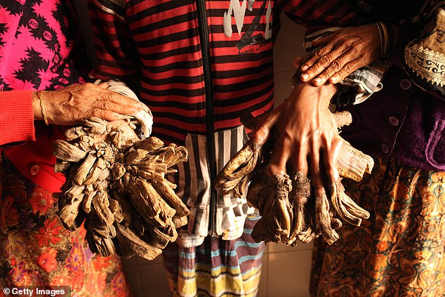 Exact figures on how many people have the condition vary from a dozen to around 200  globally