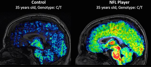 Dr Guilarte's previous study, published in JAMA Neurology, showed TSPO levels were higher in active and recently retired NFL players ranging in age from 23 to 39