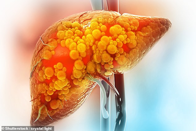 Known medically as metabolic dysfunction-associated steatotic liver disease (MASLD), the condition is not linked to heavy drinking¿the more commonly known cause of liver problems