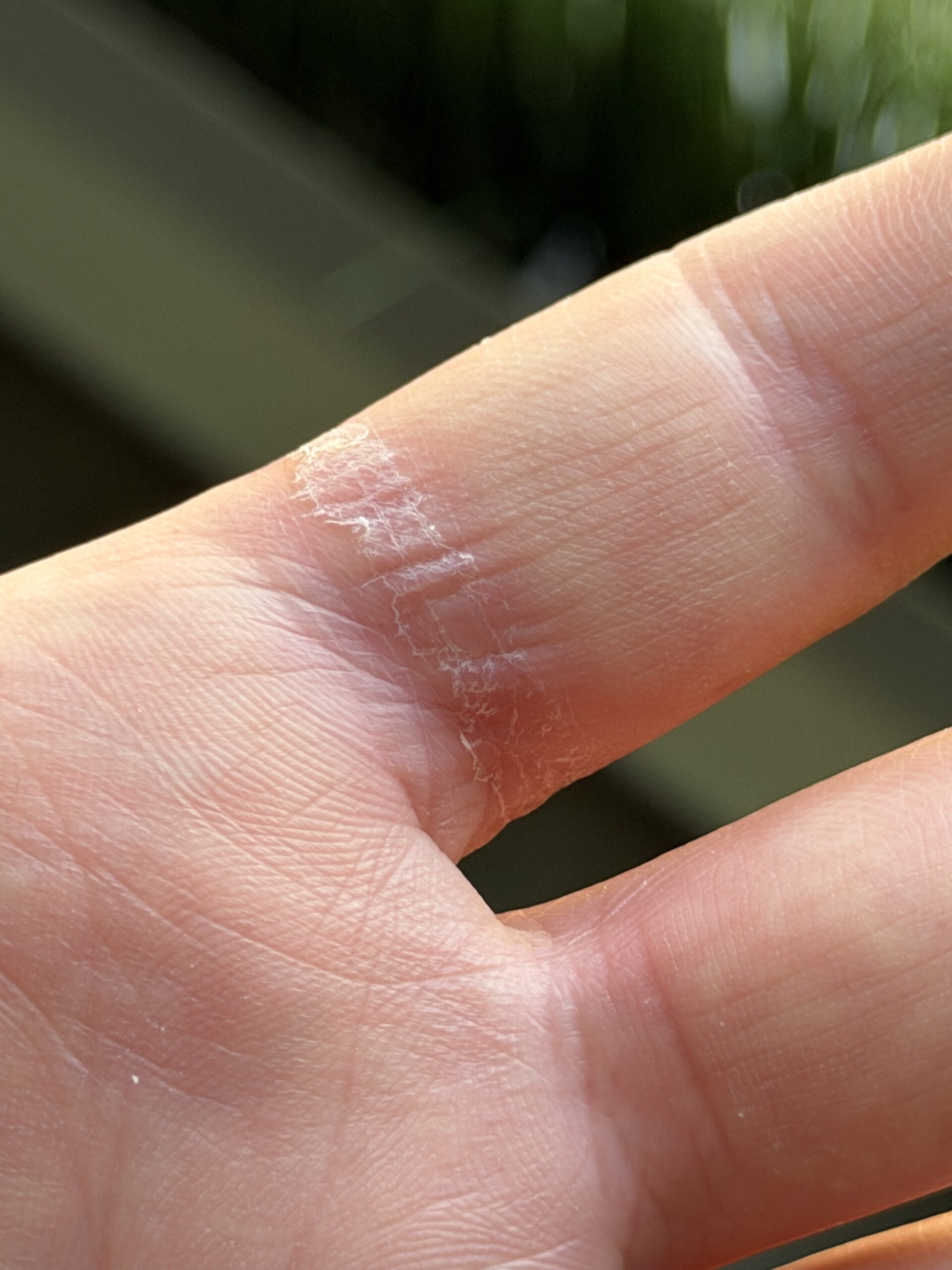 Samsung Galaxy Ring Battery Swelling Injury